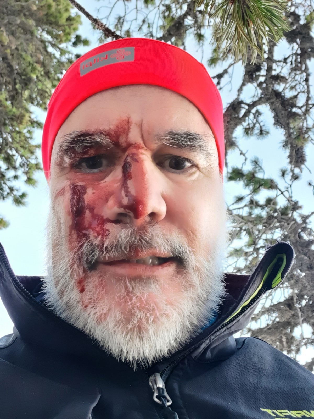 Selfie après la chute pour voir les blessures au visage